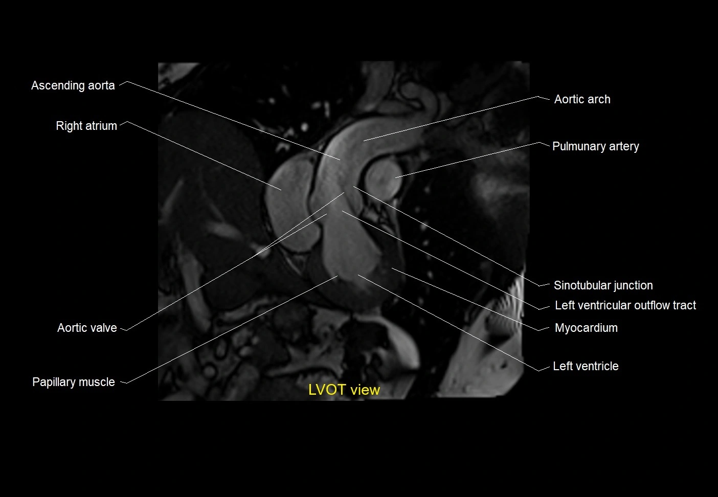 LVOT anatomy.webp